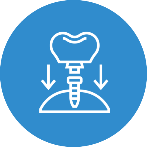 Implants dentaires